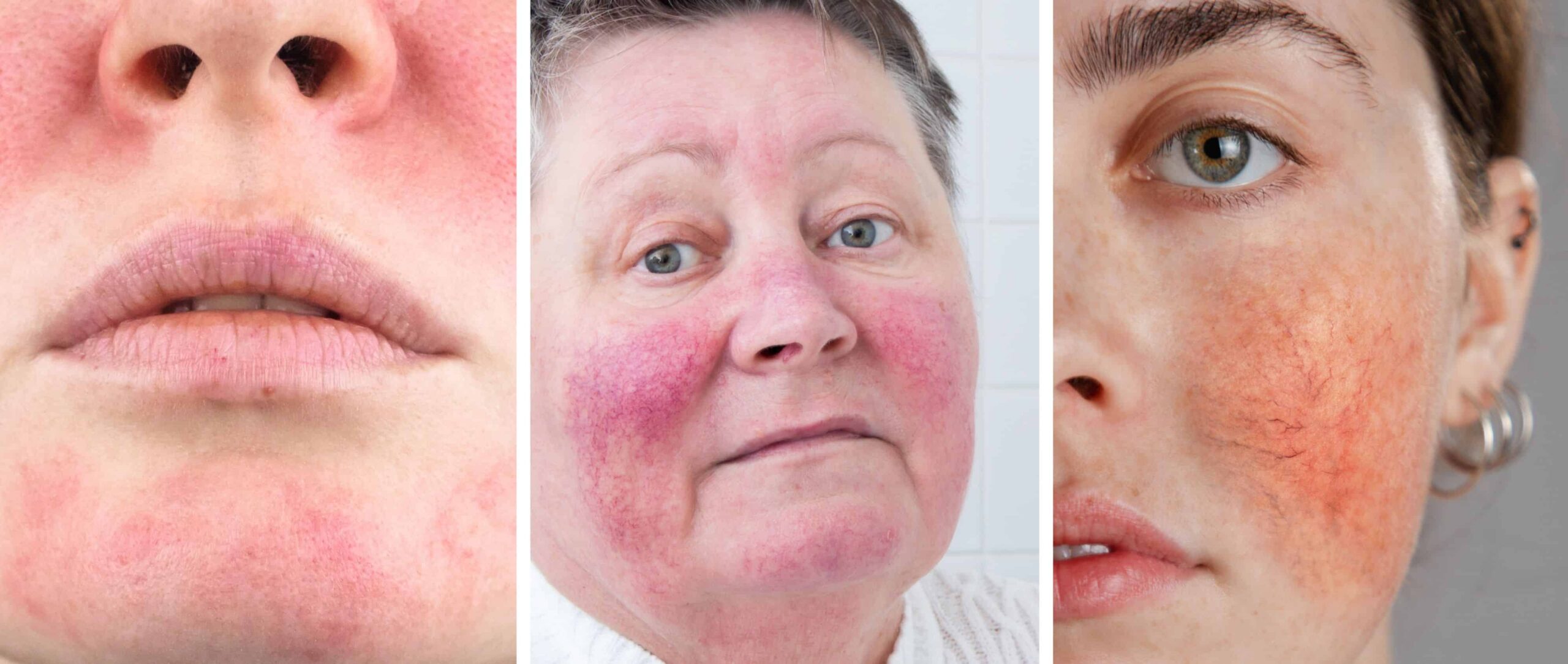 Natürliche_Behandlung_Rötungen_Rosacea_Couperose_dieNikolai_1